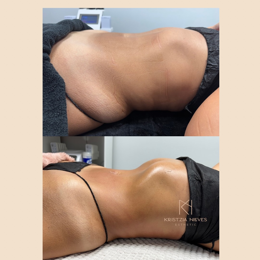 Segundo caso corporal antes y después compartido públicamente por Shalem Esthetic