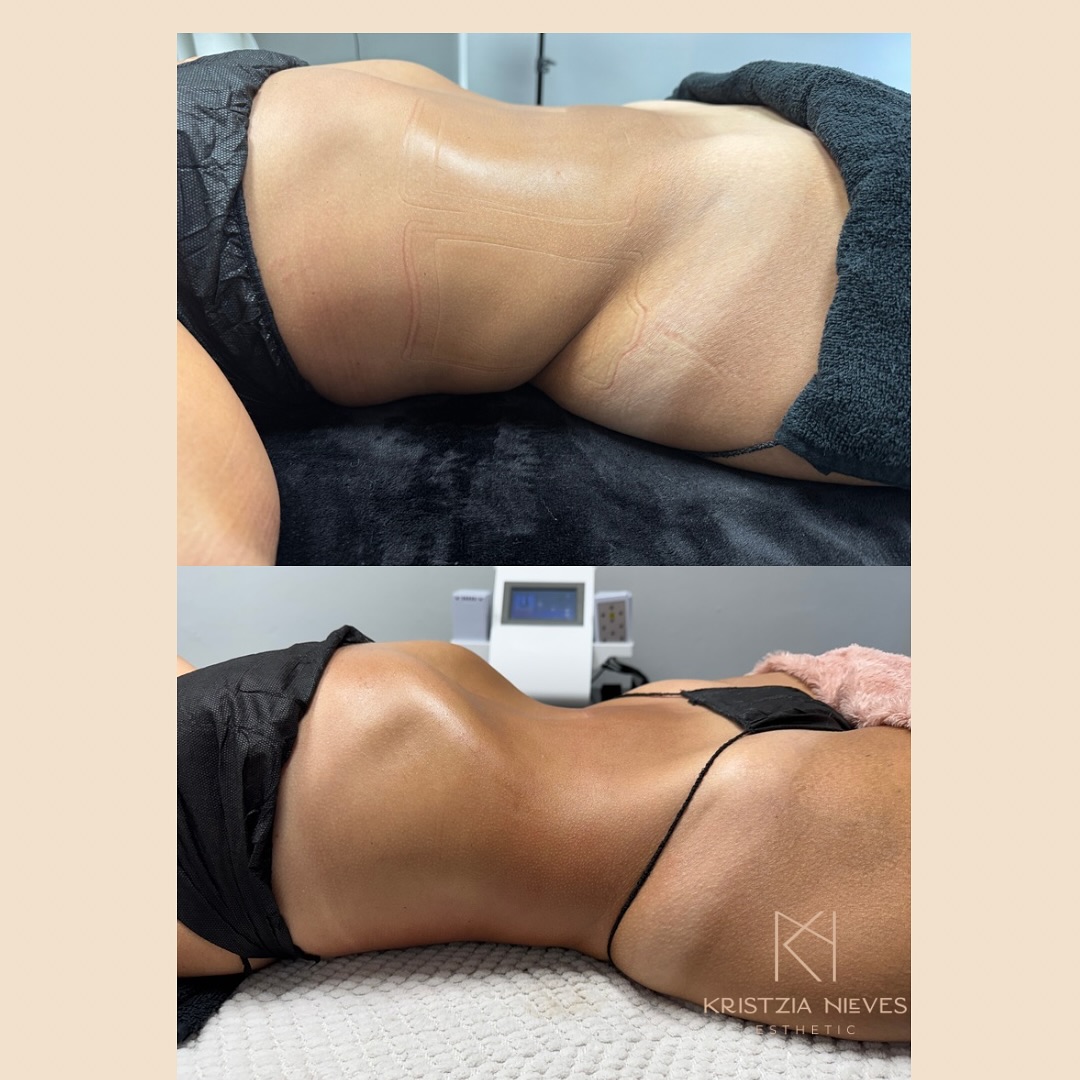 Caso corporal antes y después compartido públicamente por Shalem Esthetic