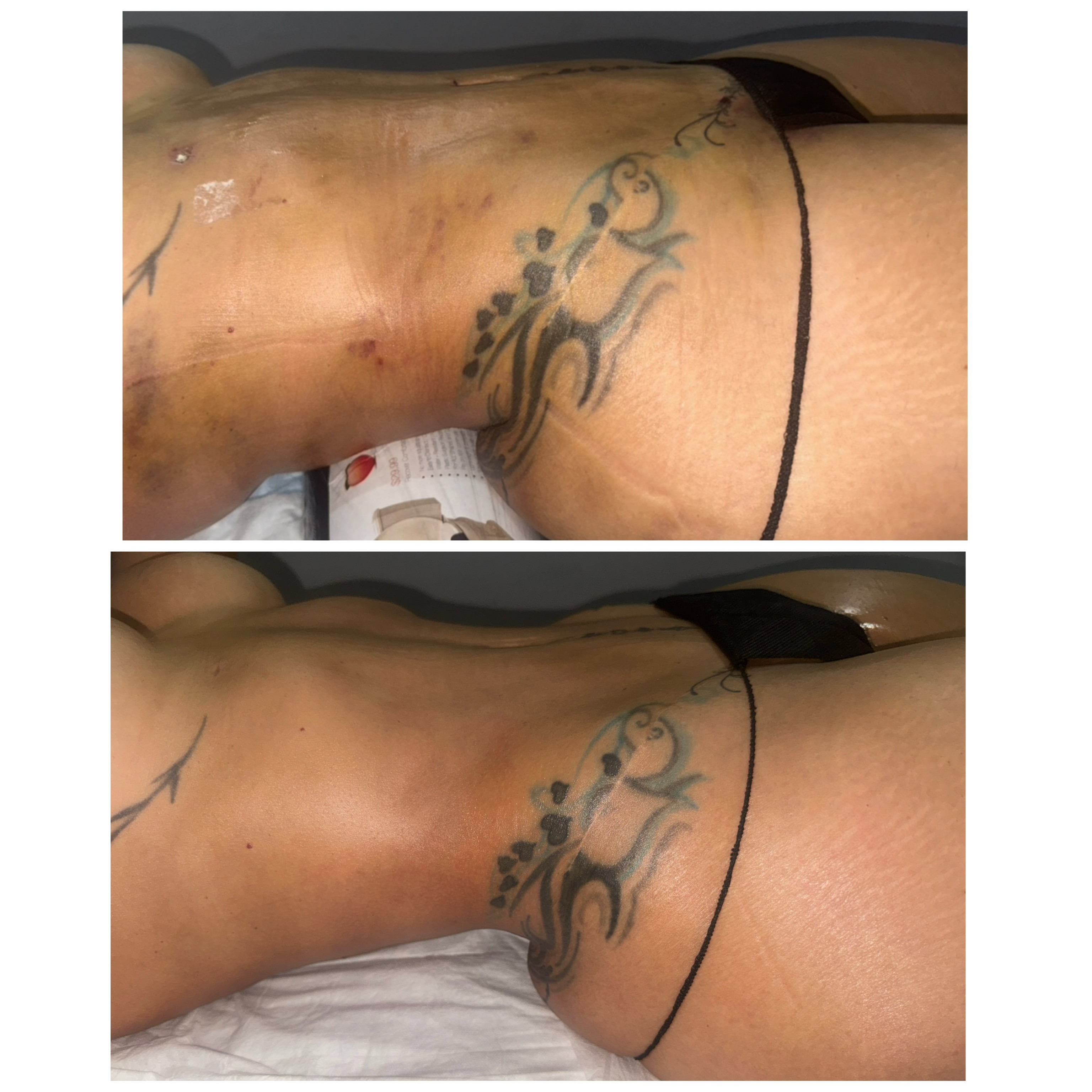 Caso postquirúrgico compartido públicamente por Shalem Esthetic
